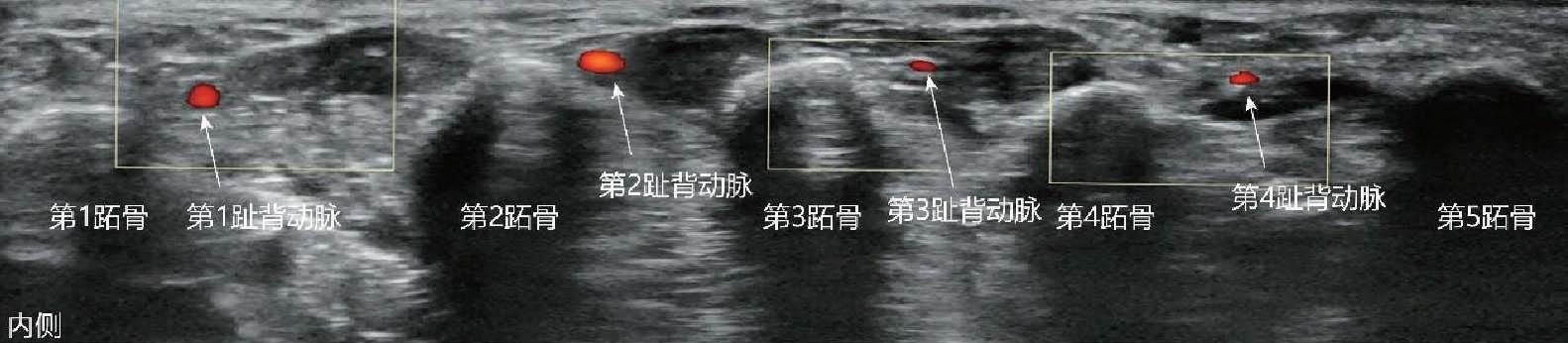 三、超聲引導腓總神經及其分支阻滯技術
